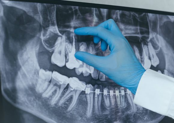 Endodonti